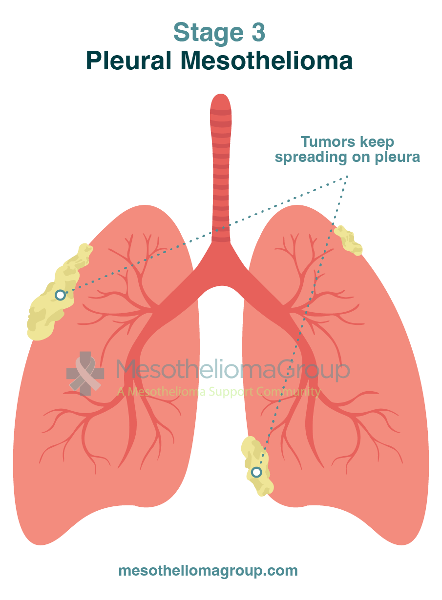 Mesothelioma Stages | Breaking Down the 4 Stages