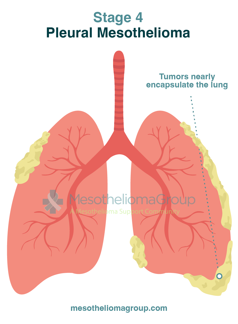Mesothelioma